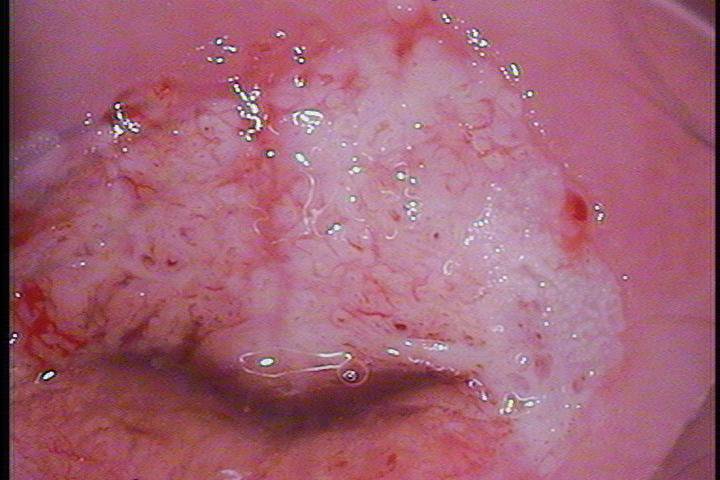 C&aacute;ncer in situ.