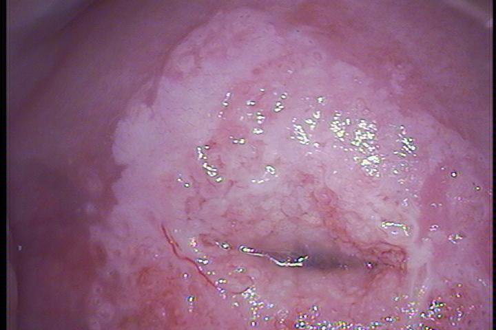 Virus del Papil&oacute;ma.